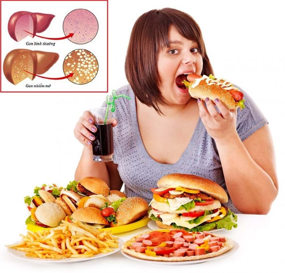 Chế độ ăn uống không khoa học cũng gây bệnh gan nhiễm mỡ độ 3