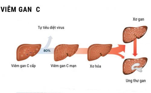 Triệu chứng bệnh viêm gan C ở từng giai đoạn